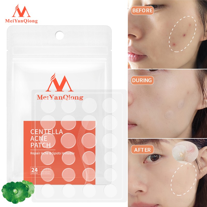 Ảnh MeiYanQiong Miếng dán lột mụn giảm mụn đầu đen Phục Hồi àm làm  sạch sâu Da cho vùng mũi 24 viên 3