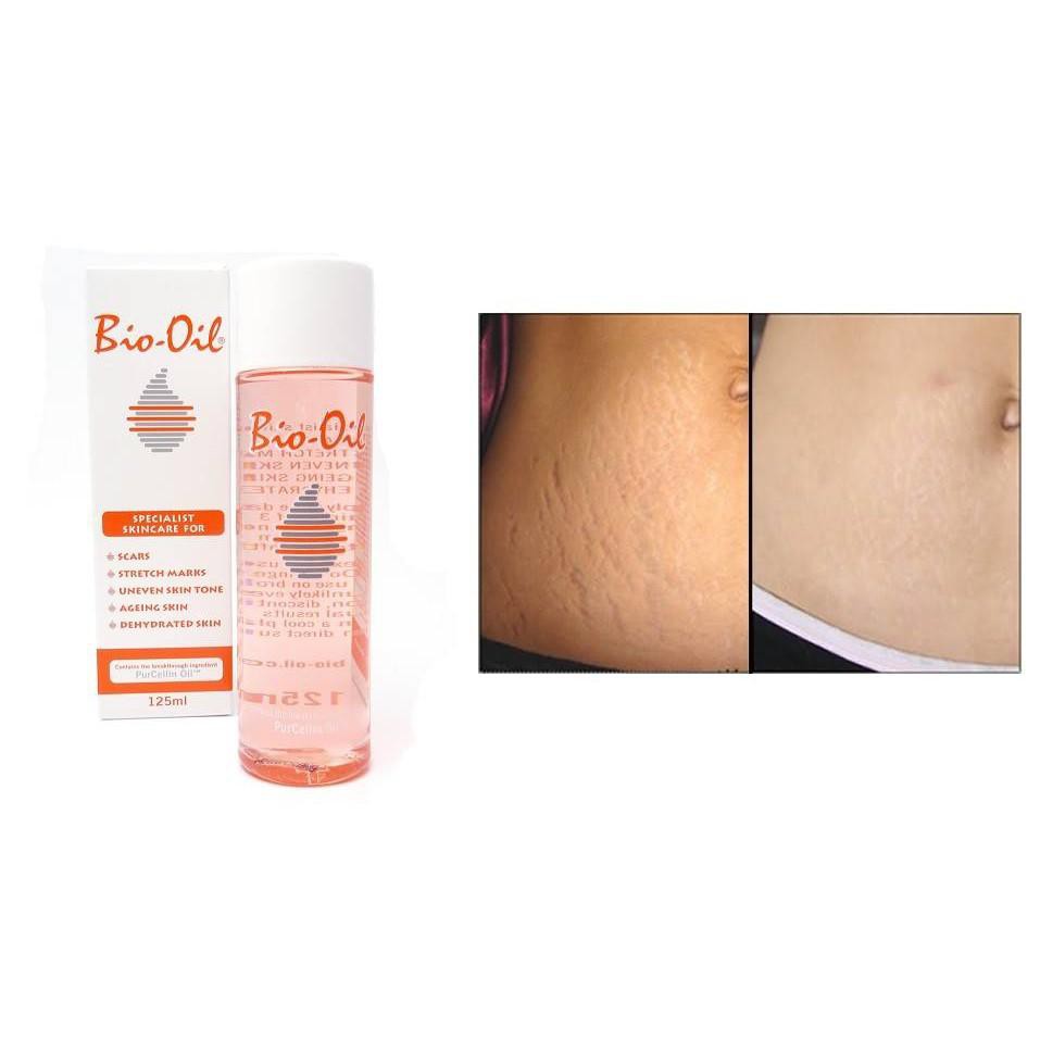 Ảnh Tinh Dầu Rạn Da, Mờ Sẹo Bio-Oil Scar Treatment Cocolux 2