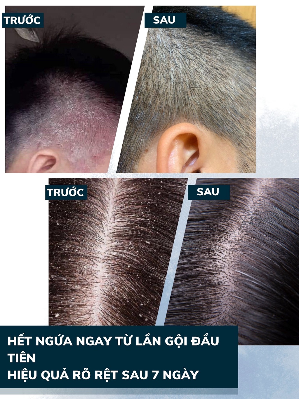 Mô tả Combo 3 Dầu Gội Sạch Nấm DEGO PHARMA 80ml - Dứt Điểm Gàu Ngứa & Nấm Da Đầu - Chiết Xuất Thiên Nhiên - 5