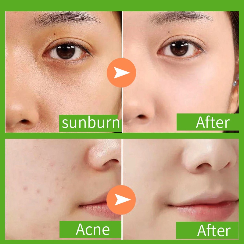Ảnh Gel lô hội PFFEE dưỡng ẩm phục hồi cháy nắng 300g 2