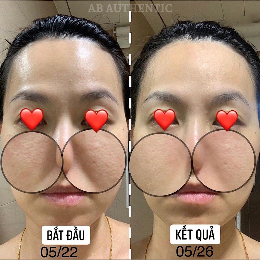 [Top 1 bán chạy] Lọ Peel tẩy da chết tái tạo da chuyên sâu CNP Rx Skin Rejuvenating Intensive Peel 5ml - AB Authentic | BigBuy360 - bigbuy360.vn