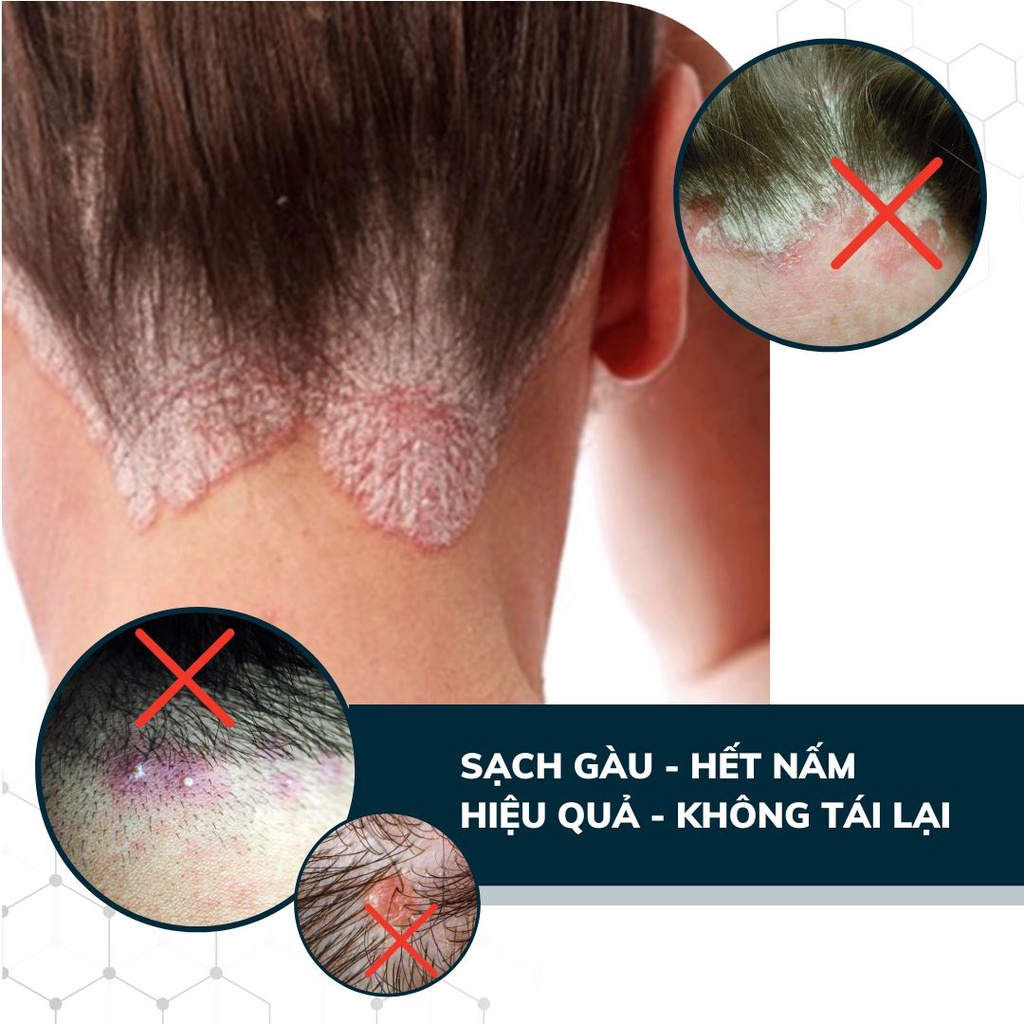 Ảnh Combo 3 Dầu Gội Sạch Nấm DEGO PHARMA 80ml - Dứt Điểm Gàu Ngứa & Nấm Da Đầu - Chiết Xuất Thiên Nhiên 3