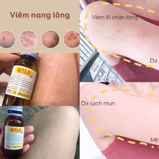 KELA LOTION dưỡng da Chống Viêm Nang, Lỗ Chân Lông 30ml,60ml