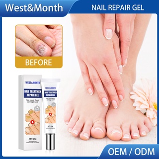 Thuốc Mỡ ALIENBENSON] Phương Tây & Tháng Loại Bỏ Nấm Móng Tay Và Móng Chân Và Tẩy Sơn Móng
