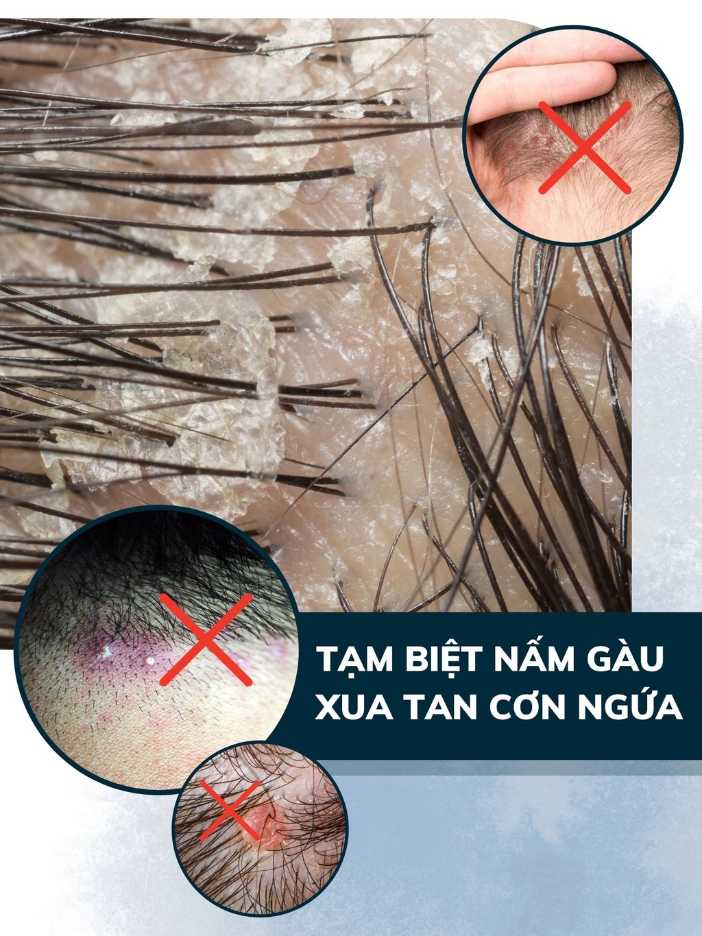 Mô tả Combo 3 Dầu Gội Sạch Nấm DEGO PHARMA 80ml - Dứt Điểm Gàu Ngứa & Nấm Da Đầu - Chiết Xuất Thiên Nhiên - 4