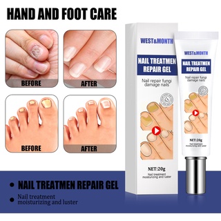 Thuốc Mỡ ALIENBENSON] Phương Tây & Tháng Loại Bỏ Nấm Móng Tay Và Móng Chân Và Tẩy Sơn Móng