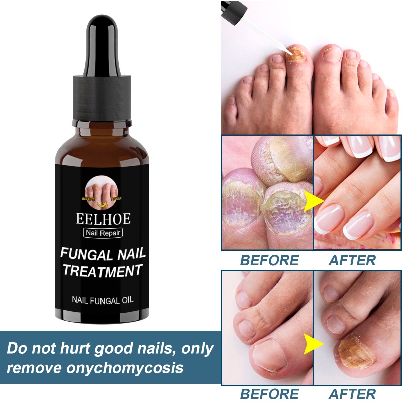 Ảnh Tinh chất phục hồi móng EELHOE ANNIES 30ml/ 50ml loại bỏ nấm chăm sóc móng tay móng chân 2