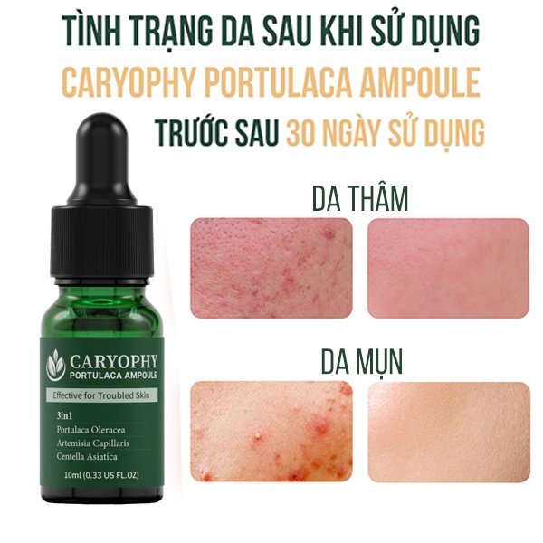 Ảnh Combo Skincare chăm sóc da giảm mụn thâm Caryophy Portulaca (sữa rửa mặt 150ml + Toner 300ml + Serum 30ml) 3
