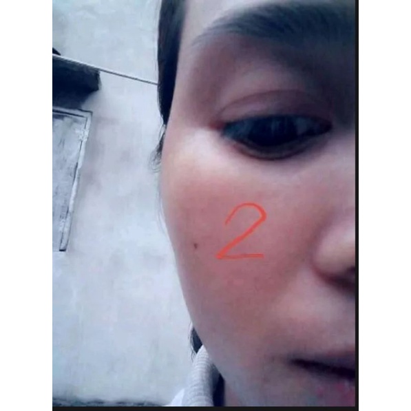 💖Com bo 5 sp chấm nán ,tàn nhang ,seo ,mụn Đức Thịnh.