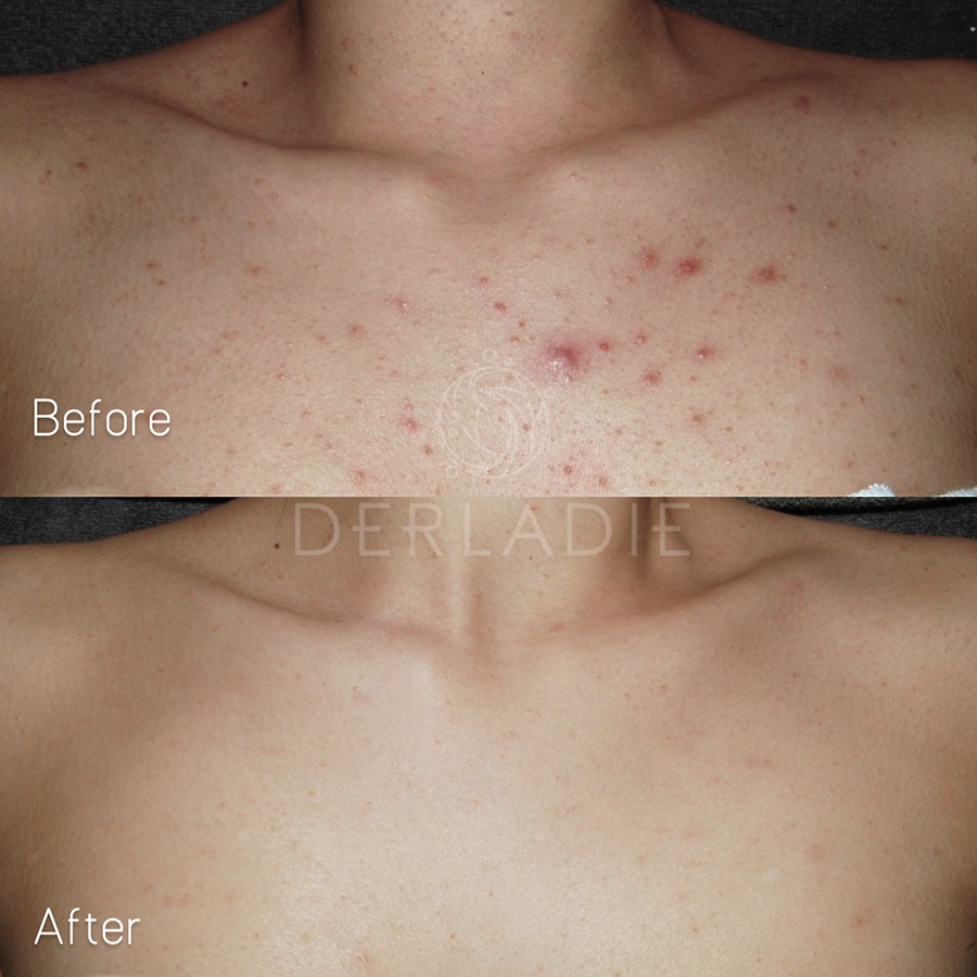 Ảnh Xà Phòng Derladie - Xà Bông Cục Giảm Mụn Lưng Cơ Thể Derladie Body Cleansing Bar Blemish Skin 50gr 3
