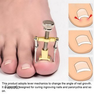Dụng Cụ Chỉnh Hình Móng Chân Mọc Ngược Tiện Dụng