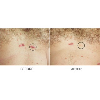 Strataderm Gel ngăn ngừa và làm mờ sẹo của Thụy Sĩ