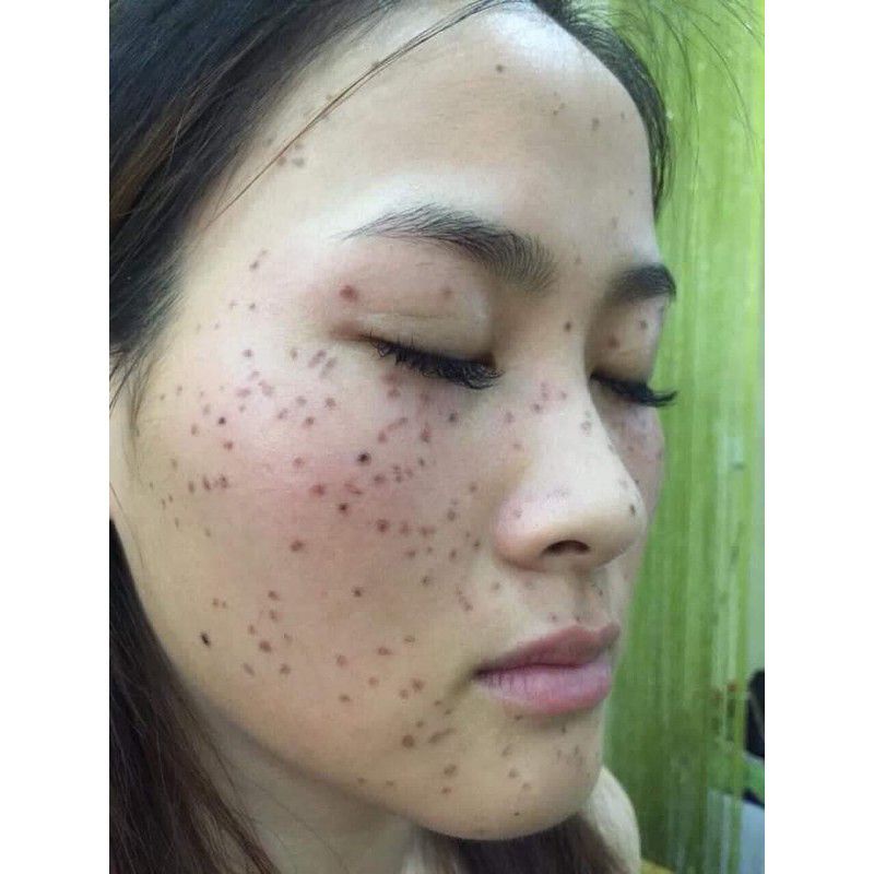 Combo 5 sp tảo sống chấm nám ,tàn nhang.