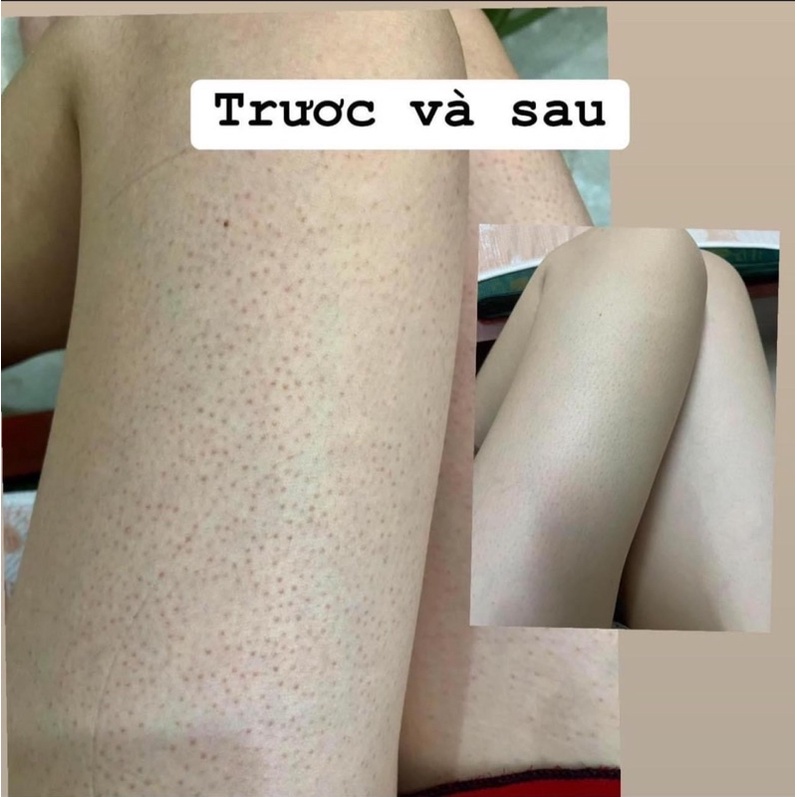 KELA LOTION DÙNG CHO VIÊM LỖ CHÂN LÔNG 30ml -60ml Thái Lan