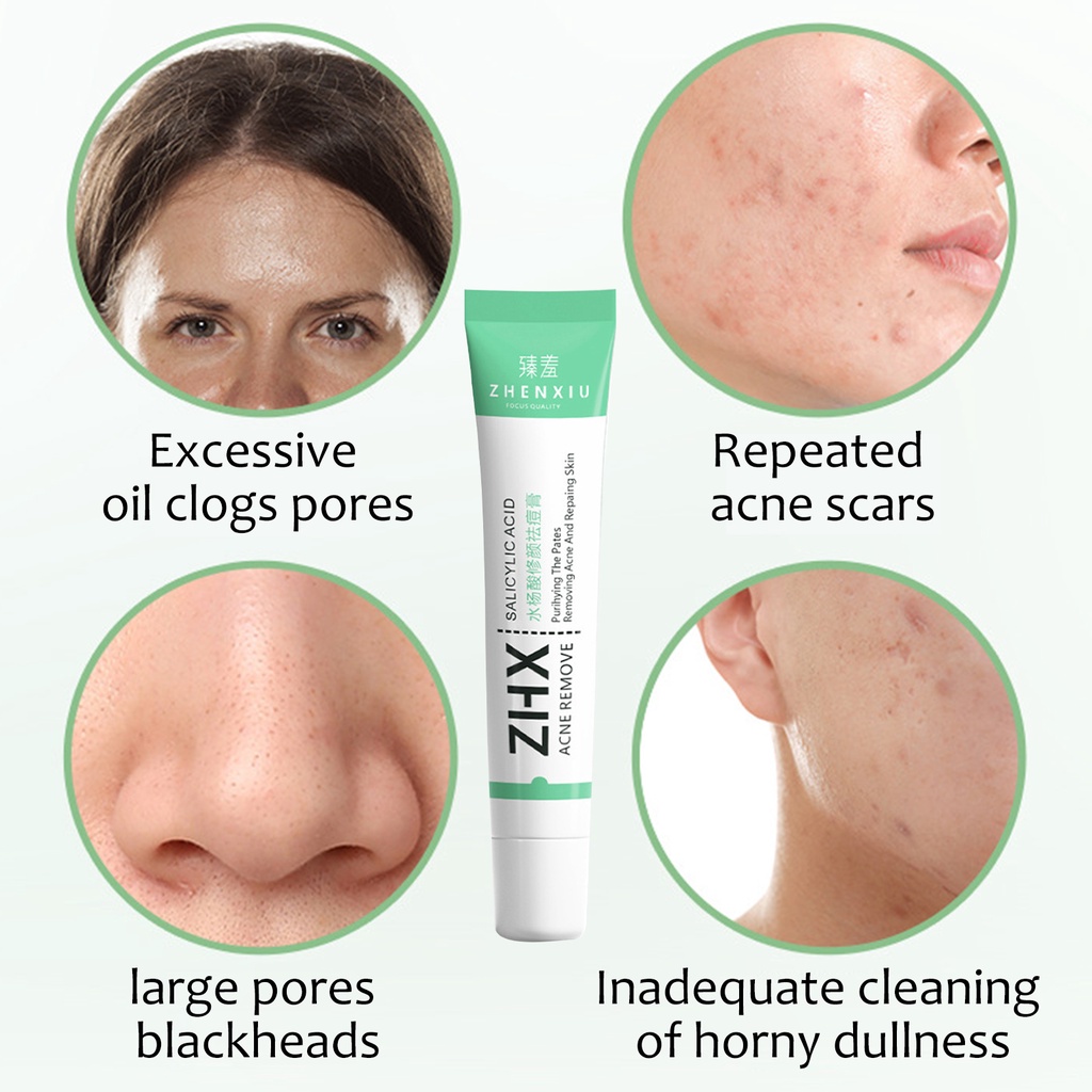 Kem Axit Salicylic Giúp Se Khít Lỗ Chân Lông Dưỡng Ẩm Và Hỗ trợ giảm mụn Đầu Đen Hiệu Quả