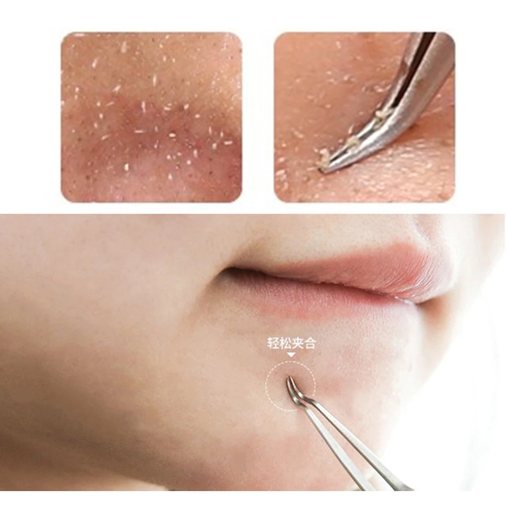 Bộ dụng cụ lấy mụn đầu đen SEVICH  bằng thép không gỉ