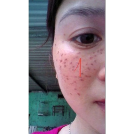 💖Com bo 5 sp chấm nán ,tàn nhang ,seo ,mụn Đức Thịnh.