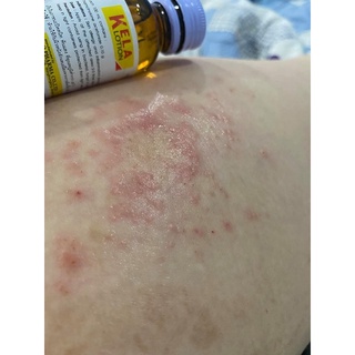 KELA LOTION dưỡng da Chống Viêm Nang, Lỗ Chân Lông 30ml,60ml