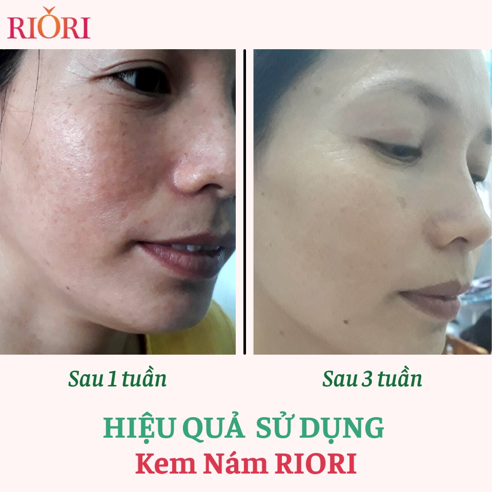 Ảnh Kem Ngừa Nám RIORI HANA MELASMA COLLAGEN CREAM 30g (Mới) 2
