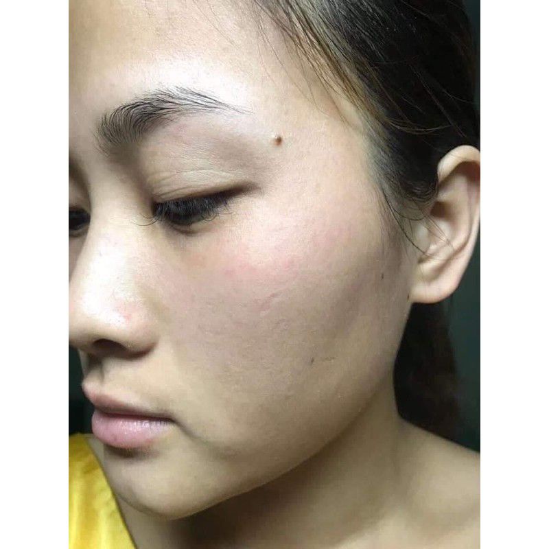 Combo 5 sp tảo sống chấm nám ,tàn nhang.