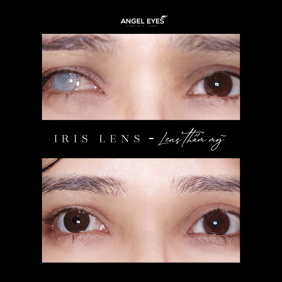 [LOẠI TỐT] Lens thẩm mỹ che khuyết điểm Angel Eyes dành cho mắt bị đục thủy tinh thế, kéo mây, cườm