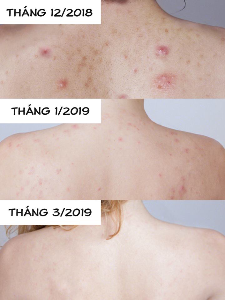 Mô tả [MUA 8 TẶNG 2] Xà phòng giảm mụn cơ thể từ lá neem Himalaya Neem Turmeric Soap 75g/ hộp - 2