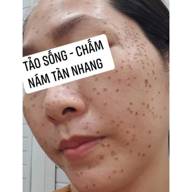 Combo 2 sp tảo sống chấm nám,tàn nhang.