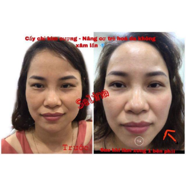 Cấy chỉ kim cương nâng cơ trẻ hóa da