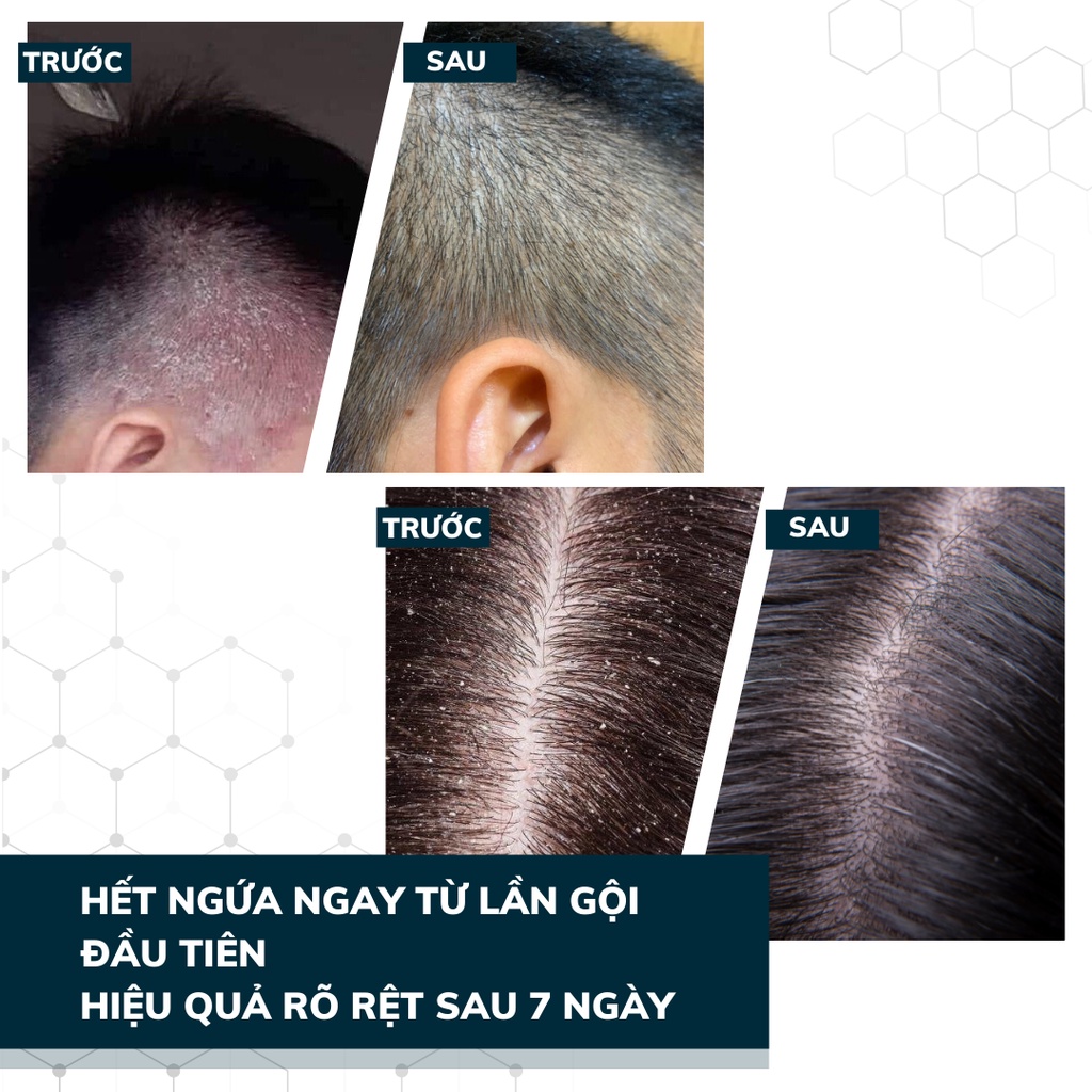 Ảnh Dầu Gội Sạch Gàu Nấm DEGO PHARMA 80ml Dứt Điểm Gàu Ngứa & Nấm Da Đầu Sau 1 Tuần 2