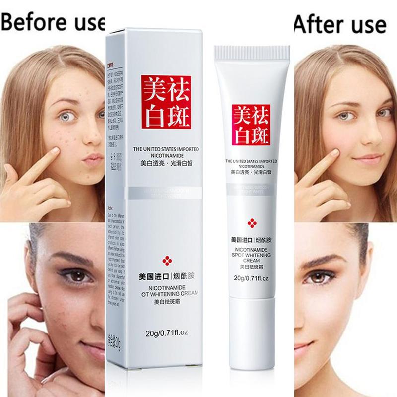 Kem Dưỡng Trắng Da Mặt Loại Bỏ Tàn Nhang Và Đốm Đen 20g