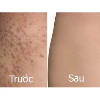 Tinh Chất Serum giảm thâm nách, mông ,bẹn, đầu gối, thâm chân tay, 30ml