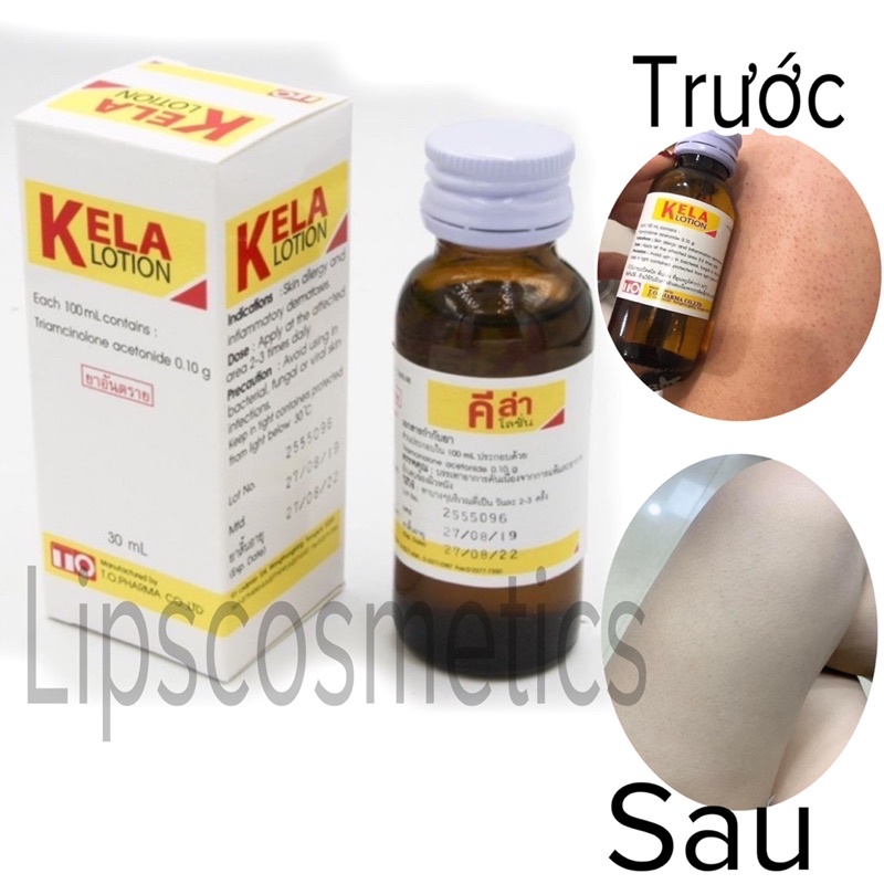KELA LOTION DÙNG CHO VIÊM LỖ CHÂN LÔNG 30ml -60ml Thái Lan