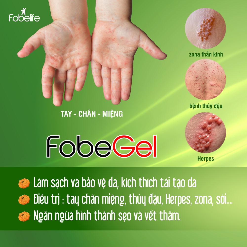 Gel Tái Tạo Anti Virus Fobe Hỗ Trợ Làm Lành Da Do Virus Gây Nên, Thủy Đậu N1