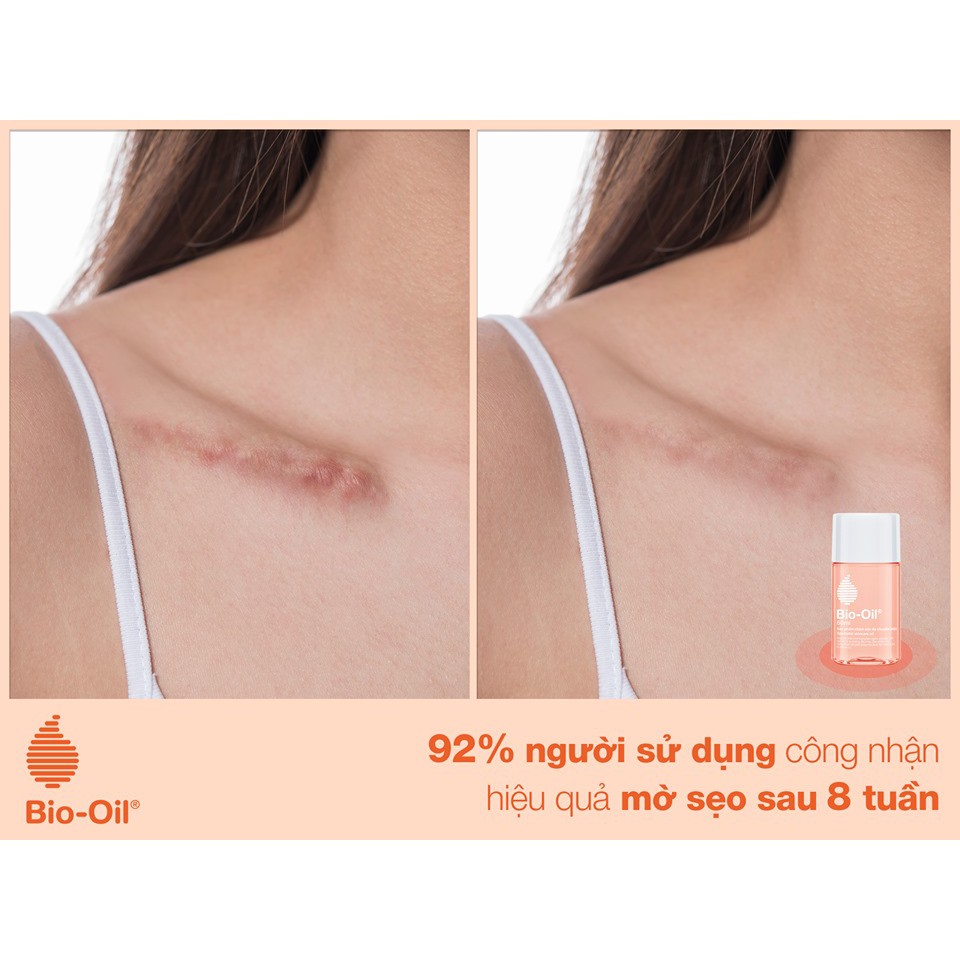 Ảnh Tinh Dầu Rạn Da, Mờ Sẹo Bio-Oil Scar Treatment Cocolux 3
