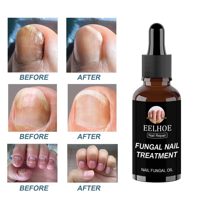 Ảnh Tinh chất phục hồi móng EELHOE ANNIES 30ml/ 50ml loại bỏ nấm chăm sóc móng tay móng chân 3