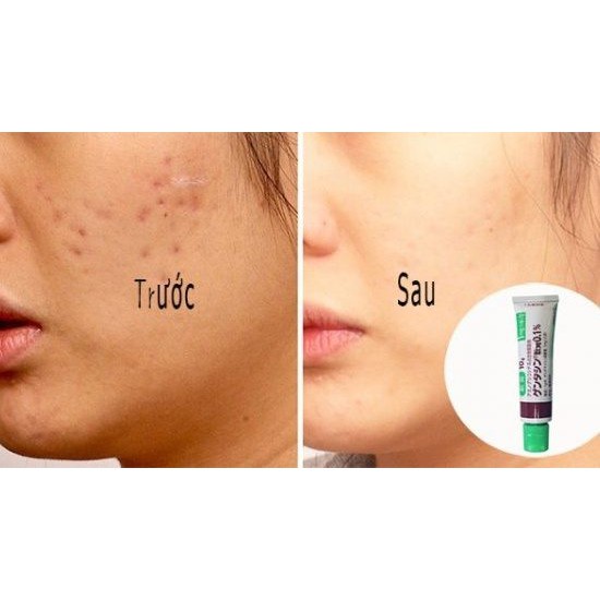 [ hộp 10 tuýp ] Kem Sẹo Gentacin Của Nhật Bản 10gr