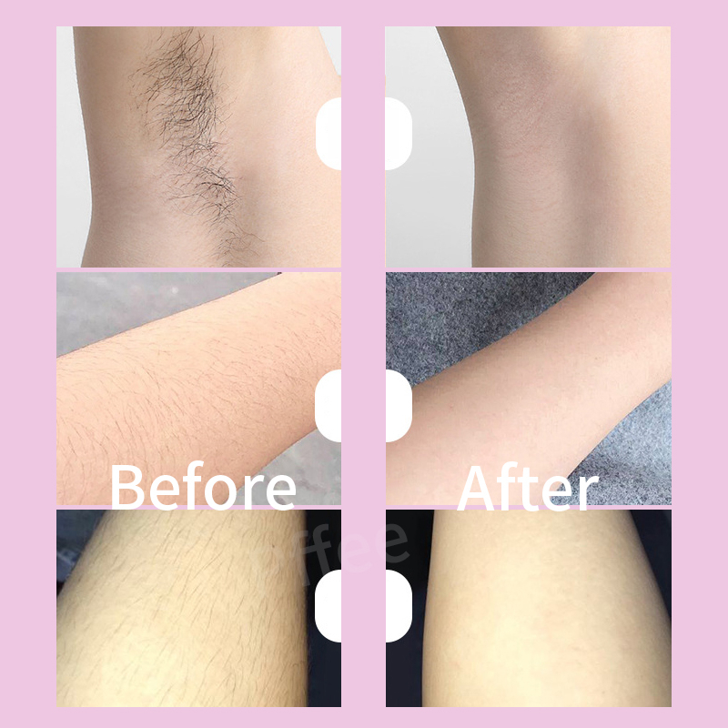 Ảnh Dụng cụ tẩy lông nano PFFEE không đau tiện lợi 1