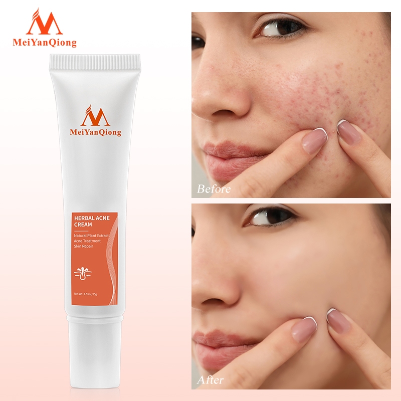 Ảnh MeiYanQiong Kem dưỡng Hỗ Trợ Giảm Mụn cải thiện da thô ráp xỉn màu làm sáng màu da 15g 2