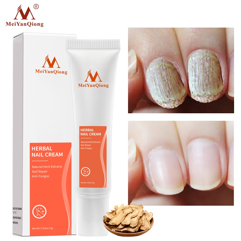 Ảnh MeiYanQiong Kem Hỗ Trợ Giảm Bệnh Nấm Móng 15g 1