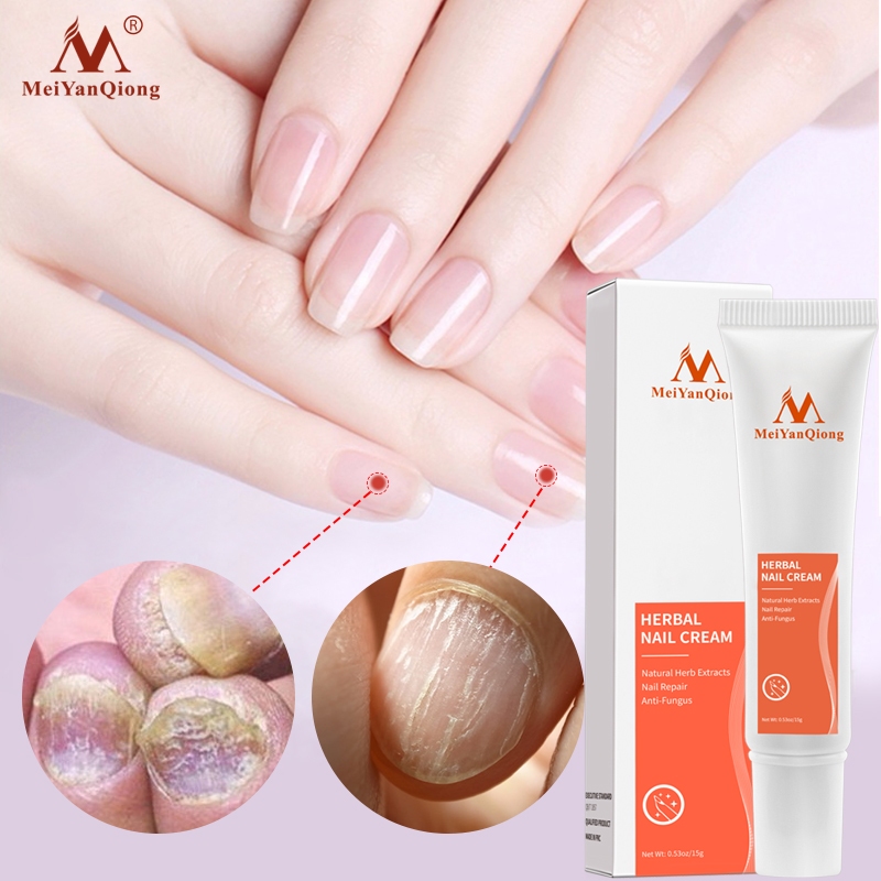Ảnh MeiYanQiong Kem Hỗ Trợ Giảm Bệnh Nấm Móng 15g 2