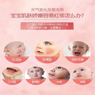 Pháp boiron Calendula Eczema Cream cho bé Kem dưỡng da mặt đỏ, dưỡng ẩm cho trẻ mới biết đi, chăm sóc da