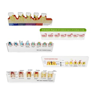 1 Cái Bệnh Nha Khoa Bột Rễ Điều Trị Kênh Phân Giải Biểu Đồ Lưu Lượng Thích Hợp Cho Nha Sĩ Truyền Thông Giảng Dạy Và Đào Tạo