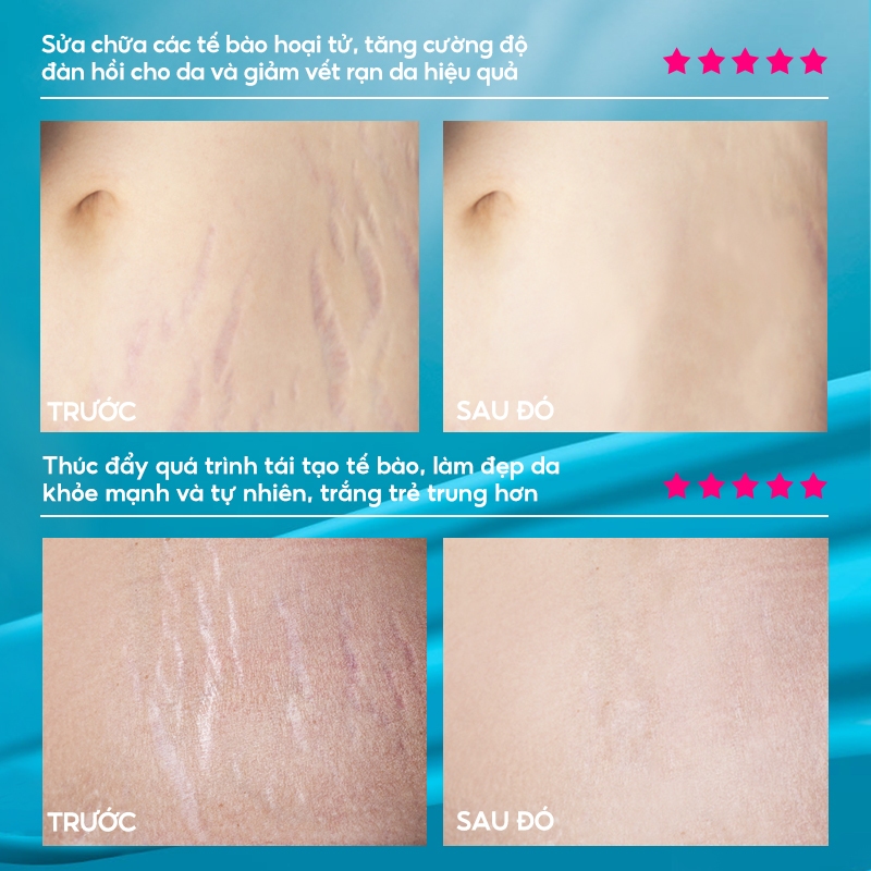 Ảnh RtopR Xoài Xóa Sẹo Mang Thai Kem Rạn Da Kem Làm Săn Chắc Cơ Thể 40g RtopR Mango Remove Pregnancy Stretch Marks Maternity Cream 4