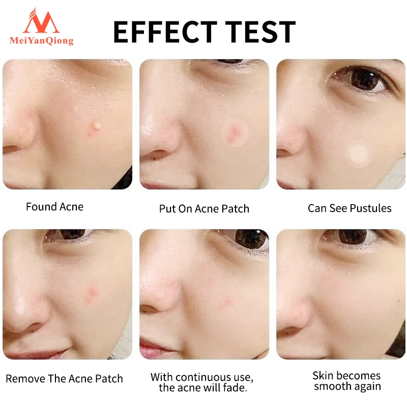 Ảnh Meiyanqiong Miếng dán lột mụn đầu đen Sửa chữa và làm sạch sâu da mặt 24 viên 4