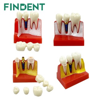 1 Cái Cấy Nha Khoa Dạy Vương Miện Cầu Có Thể Tháo Rời Mô Hình Răng Sứ Mô Hình Trình Diễn Nha Khoa Cho Nha Sĩ Giảng Dạy