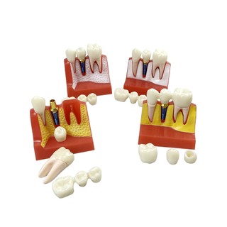 1 Cái Cấy Nha Khoa Dạy Vương Miện Cầu Có Thể Tháo Rời Mô Hình Răng Sứ Mô Hình Trình Diễn Nha Khoa Cho Nha Sĩ Giảng Dạy