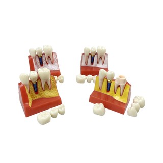 1 Cái Cấy Nha Khoa Dạy Vương Miện Cầu Có Thể Tháo Rời Mô Hình Răng Sứ Mô Hình Trình Diễn Nha Khoa Cho Nha Sĩ Giảng Dạy