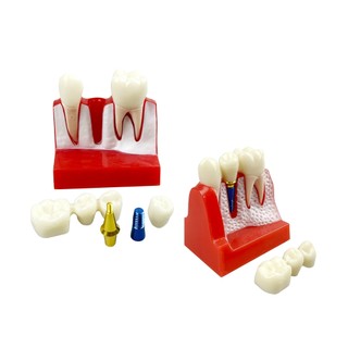 1 Cái Cấy Nha Khoa Dạy Vương Miện Cầu Có Thể Tháo Rời Mô Hình Răng Sứ Mô Hình Trình Diễn Nha Khoa Cho Nha Sĩ Giảng Dạy