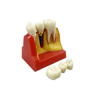 1 Cái Cấy Nha Khoa Dạy Vương Miện Cầu Có Thể Tháo Rời Mô Hình Răng Sứ Mô Hình Trình Diễn Nha Khoa Cho Nha Sĩ Giảng Dạy