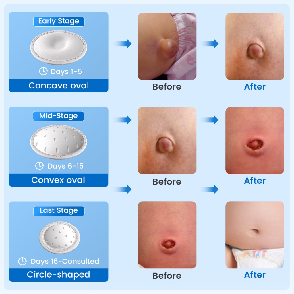 Ảnh Velpeau Đai thoát vị rốn cho bé Sơ sinh Trẻ sơ sinh Giàn rốn Nút bụng Dây đeo phục hồi với 3 miếng nén Chống trượt 3